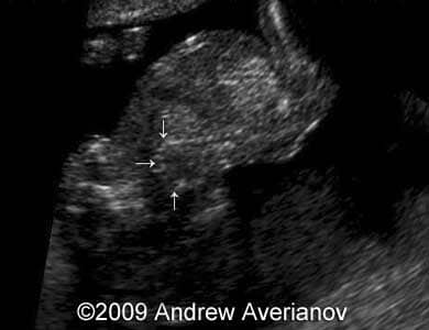 iniencephaly3
