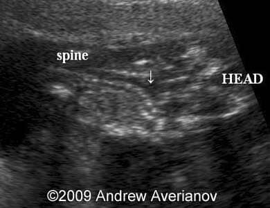 iniencephaly4