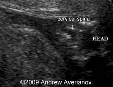 iniencephaly5