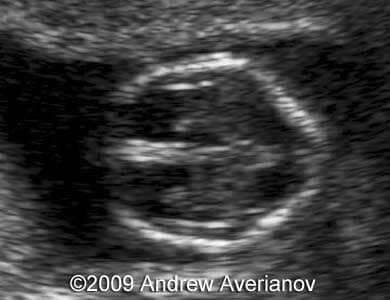 iniencephaly6