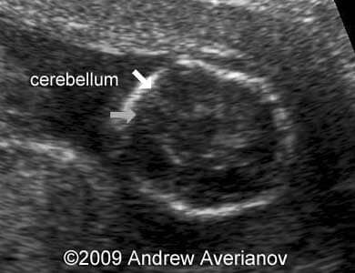 iniencephaly7
