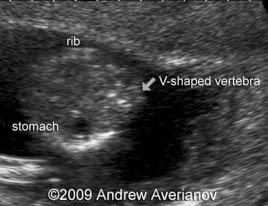 iniencephaly8