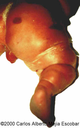 klippel trenaunay weber 2-birth