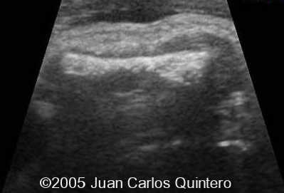 L HUMERUS