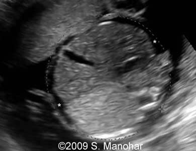 Larynx_1