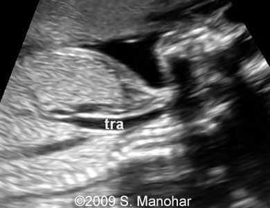 Larynx_10