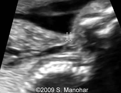 Larynx_11