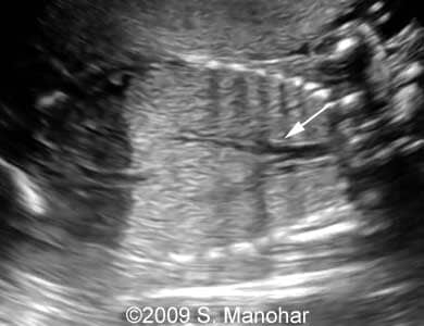 Larynx_3