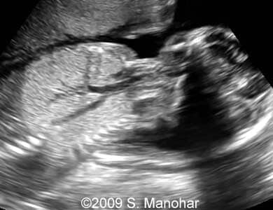 Larynx_4