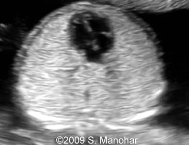 Larynx_6