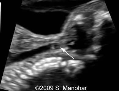 Larynx_8