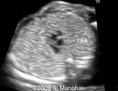 Larynx_9
