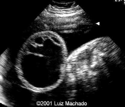 lbwc-2
