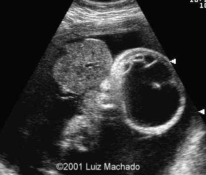 lbwc-3