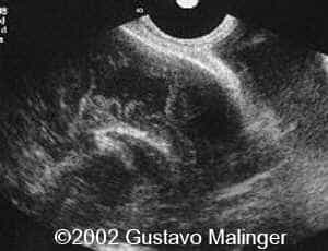 lipoma-1