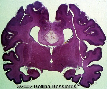 lipoma