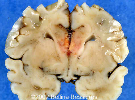 lipoma1