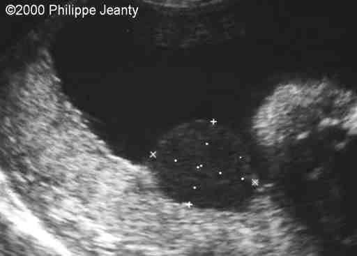 lipoma1