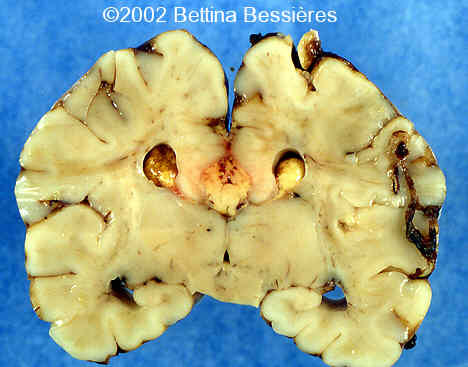 lipoma2