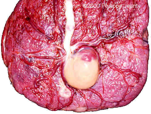 lipoma2