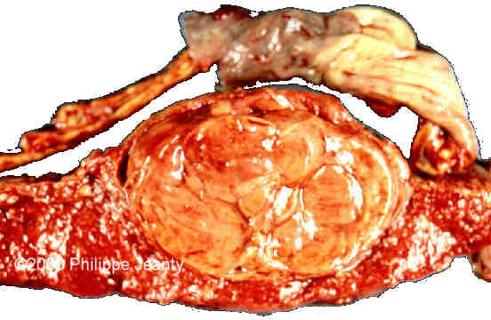 lipoma3