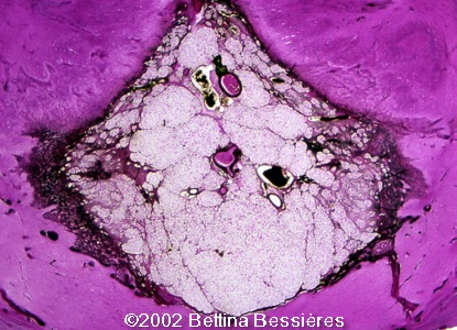 lipoma4