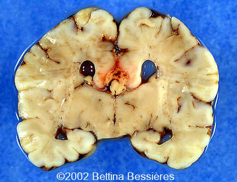 lipoma5