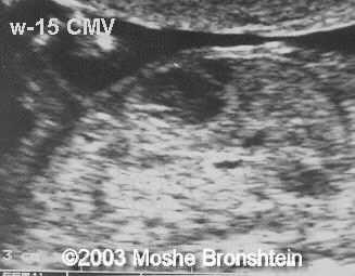 liver hematoma