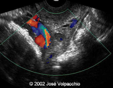 long transvaginal doppler color