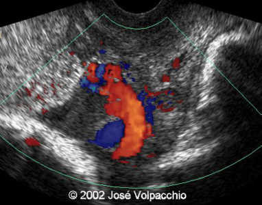long transvaginal doppler color2