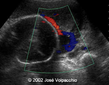 longitudinal color doppler transabdominal