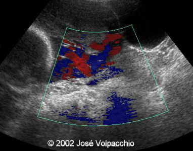 longitudinal transabdominal view doppler color
