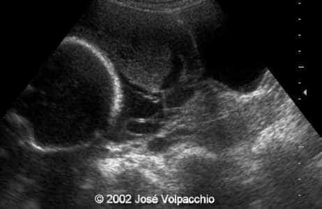 longitudinal transabdominal view