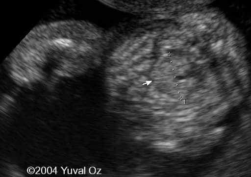 Lt P Kidney Rt Blood Sup (2)