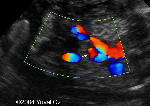 Lt P Kidney Rt Blood Sup (4)