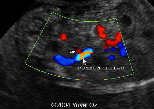Lt P Kidney Rt Blood Sup (5)