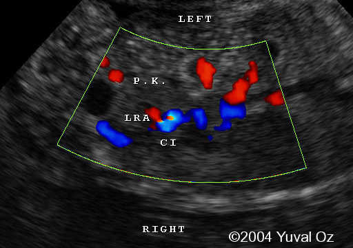 Lt P Kidney Rt Blood Sup (6)