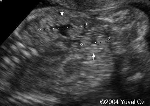 Lt P Kidney Rt Blood Sup