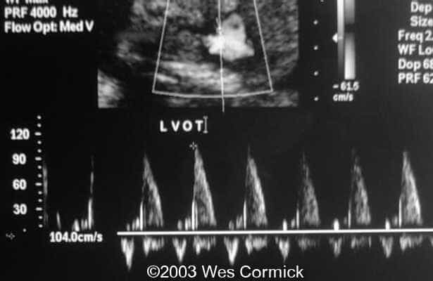 lvot