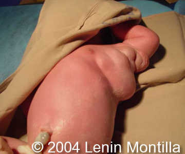 lymph3