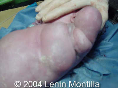 lymph5