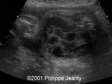 meconium_peritonitis_5