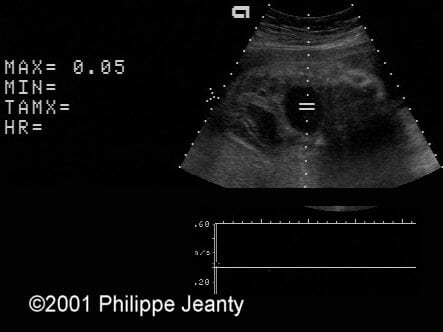 meconium_peritonitis_9