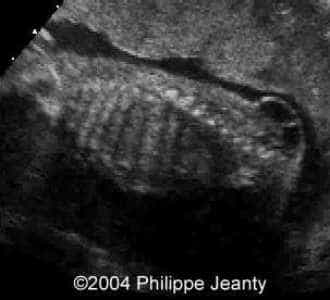 meningocele-lumbar1