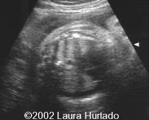 Pleural effusion
