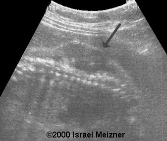 myofibromatosis-1