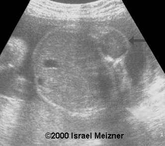 myofibromatosis2