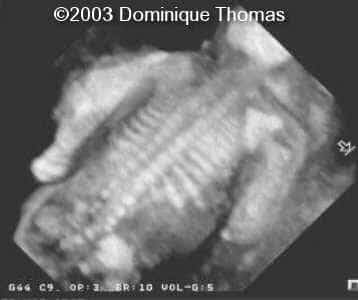 nanisme3d colonne noir