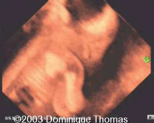 nanisme3d tete-thorax oreilel