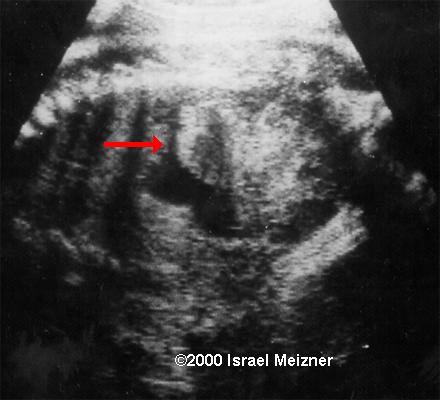 neuroblastoma_meizner